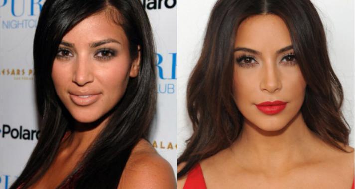 11 celeb, akire szinte rá sem lehet ismerni plasztikai műtétei után