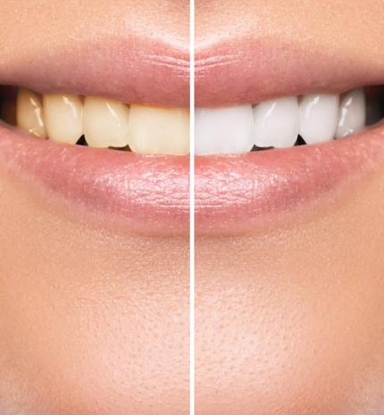 Hogyan lehet elkerülni a fogak elszíneződését?