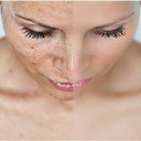 Hogyan kezeljük a pigmentfoltokat? - Szépség, divat, életmód, stílus