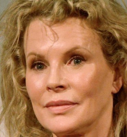 A legnagyobb hollywood-i botoxkatasztrófák