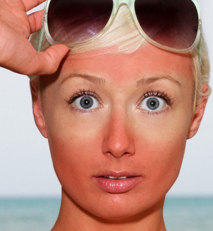 Napozás okozta foltok bőrünkön